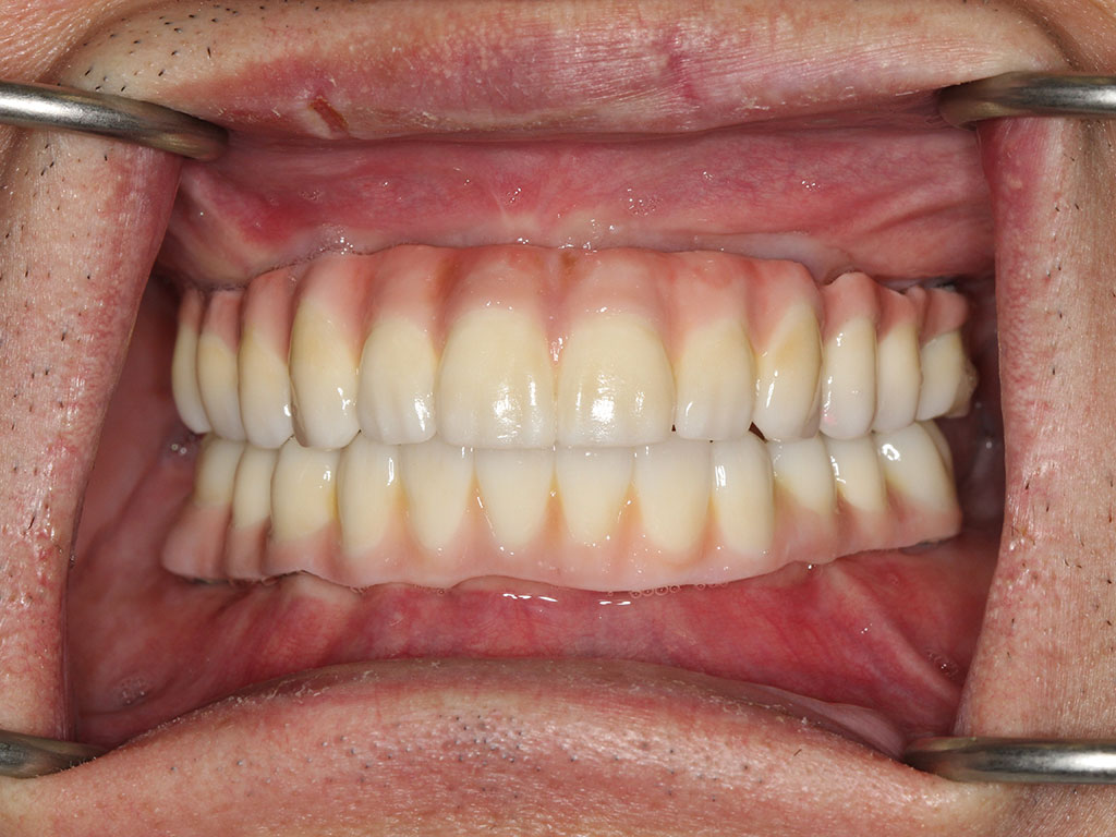 view of full teeth after All-on-4 treatment