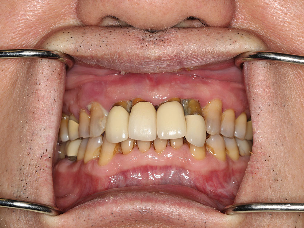 view of full teeth before All-on-4 treatment