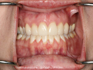 View of full teeth after Anterior 6 Maxillary Crowns