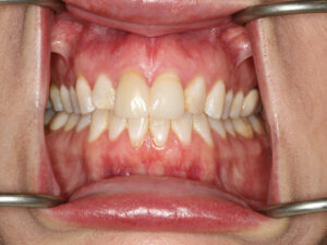 View of full teeth before Anterior 6 Maxillary Crowns