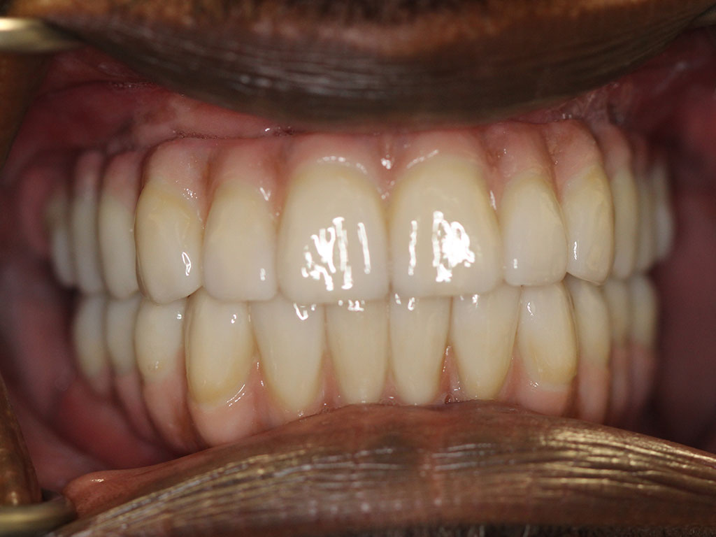A full mouth view after All-on-4 treatment