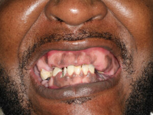 A full mouth view before All-on-4 treatment